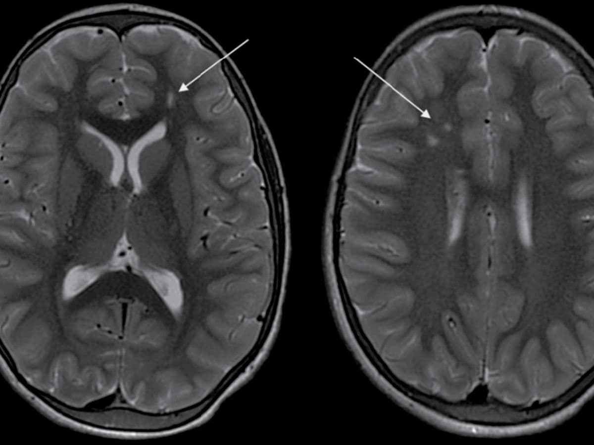 Beating Moyamoya: How Timely Surgery Transformed an 11-Year-Old’s Life