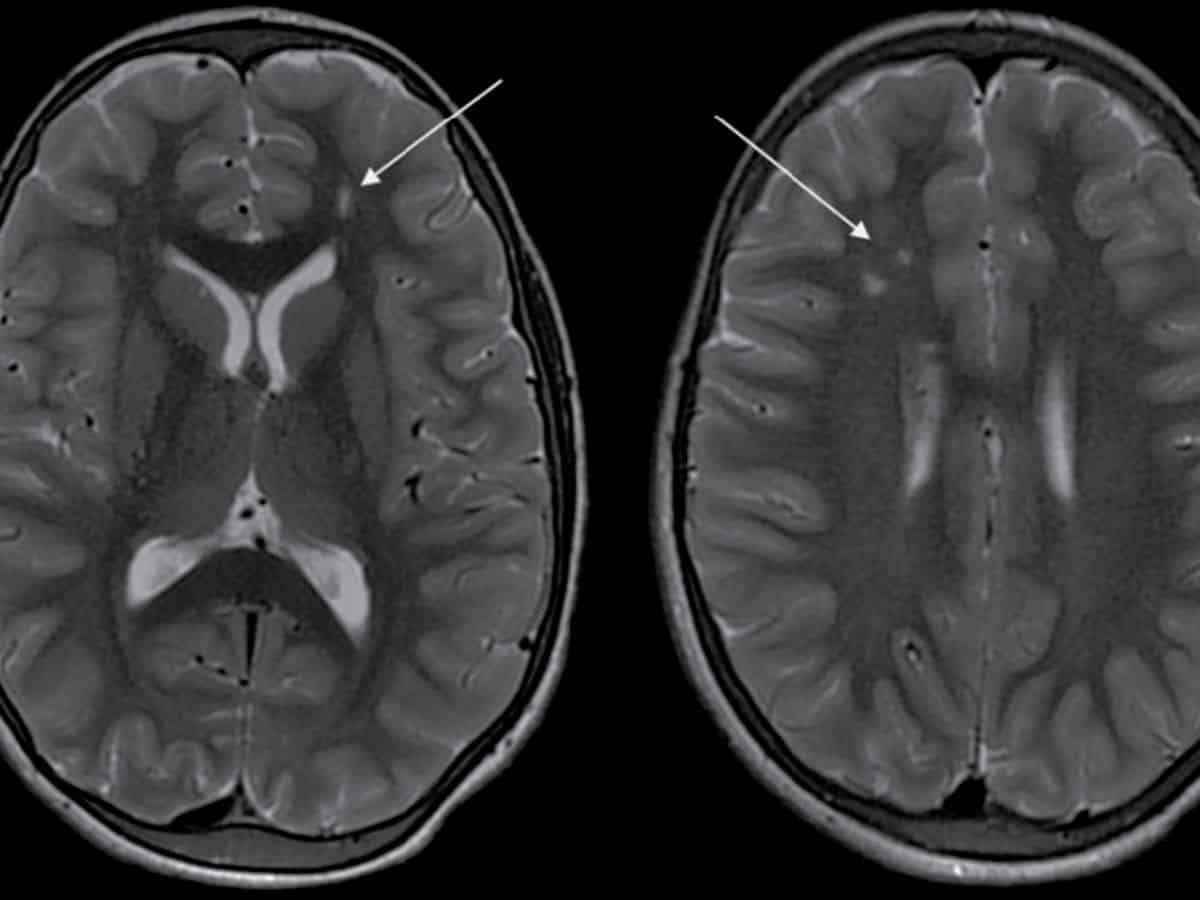 Beating Moyamoya: How Timely Surgery Transformed an 11-Year-Old’s Life